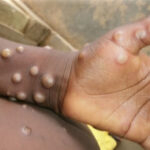 Mpox: OMS avalia risco de disseminação global da doença; Brasil registra mais de 700 casos