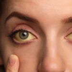 Olhos amarelados: conheça 7 possíveis causas e como tratar o problema!