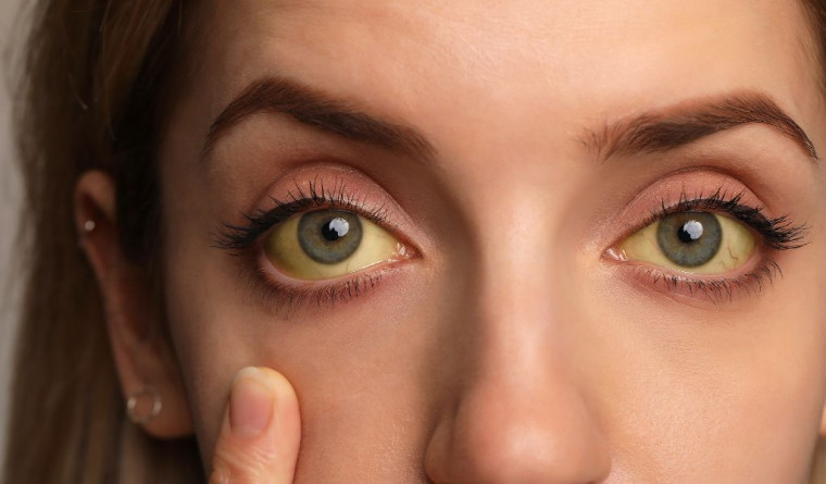 Olhos amarelados: conheça 7 possíveis causas e como tratar o problema!