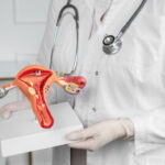 Adenomiose: sintomas, causas e tratamentos para aliviar a dor e o sangramento abundante
