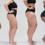 Lipedema: uma doença silenciosa que afeta milhões e é confundida com obesidade